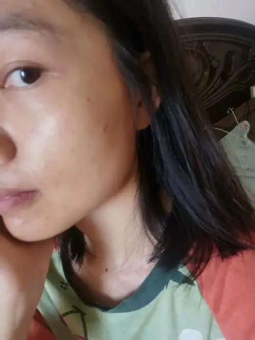 感觉这段时间的皮肤状态真的很差,脸上长了很多小痘痘,就像闭口那种的