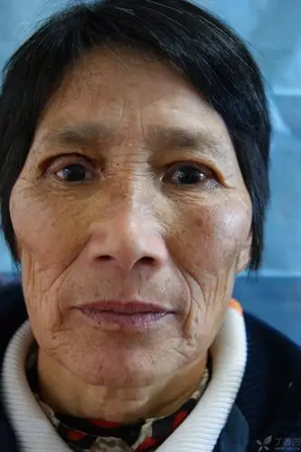 【讨论】重睑矫正老年睑内翻倒睫毛一例 - 修复重建和烧伤整形