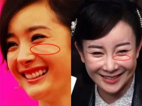 女明星没有它就会死减龄神器玻尿酸究竟应该怎么用