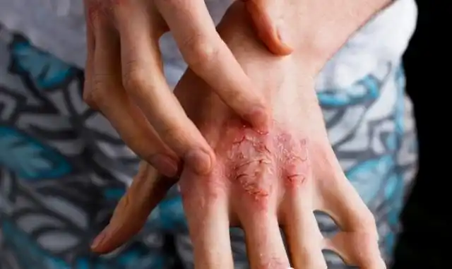 轻度牛皮癣症状图片_银屑病求医网