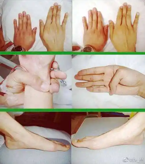 马方综合征又称为马凡综合征,为一种遗传性结缔组织疾病