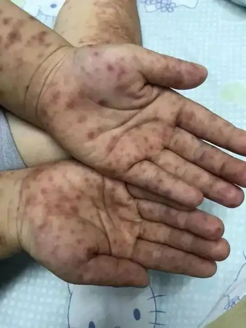 手足口病进入高发期!有了这些症状要警惕