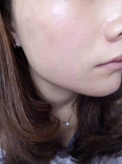 还是化妆品过敏呀?脸上好痒的!