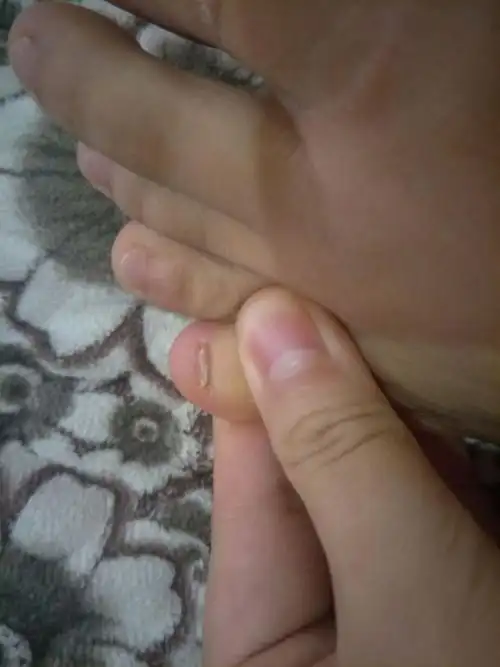 小脚趾没有脚指甲盖,只有一个类指甲的丁?