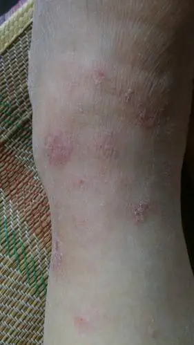 老年人皮肤病,怎么办?