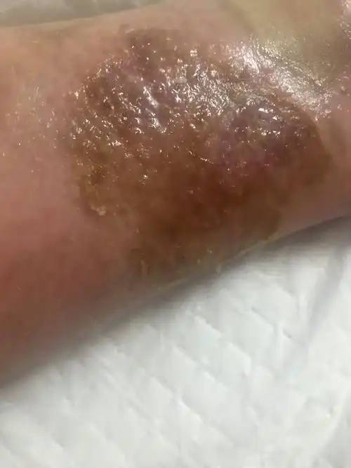 宝宝今年一岁多脚背被开水烫伤诊断为深二度烧伤已经两个月了怎样减少