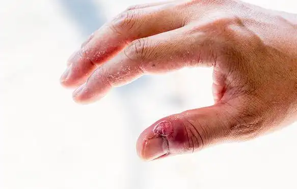 放开指甲,别再咬了!爱咬指甲的人快来看看,这些危害!!