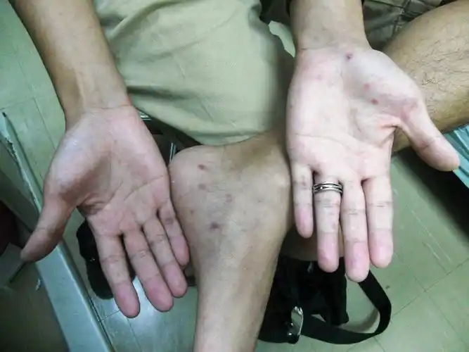 疾病的注意事项【图】男性早期梅毒图片 临床上梅毒初期症状表现是