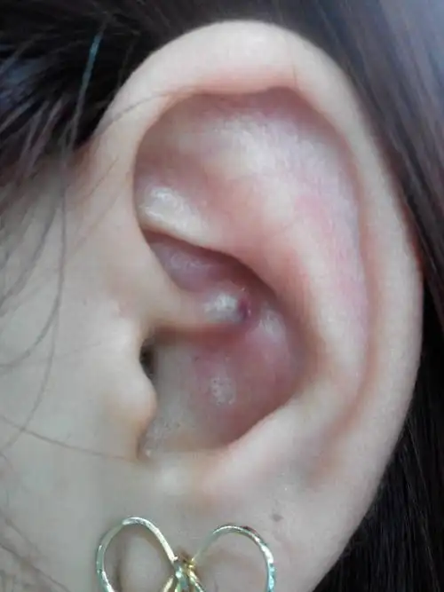 这几天耳朵突然长了一个大疙瘩,按下去会疼.