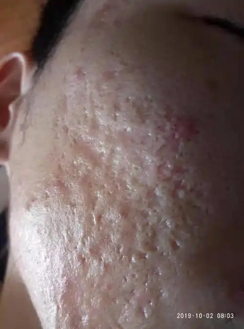 吴余乐(副主任医师):你好,我看了你上面的图片,你的疤痕特别严重,首先