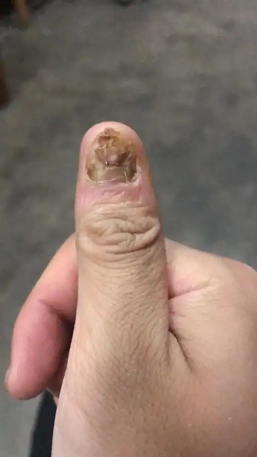 灰指甲40实例甲萎缩应该怎么办