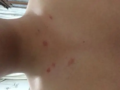 上月底找过 戴套了最近一周有这个就颈部有一些会痒会是艾滋吗_艾滋病