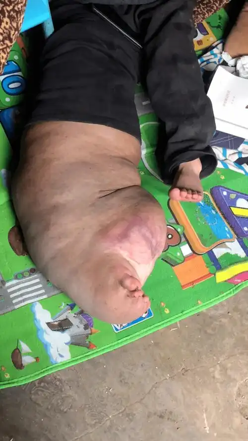 被网友们称为"象腿男孩"让人看到忍不住心疼差不多有40斤重右腿出现