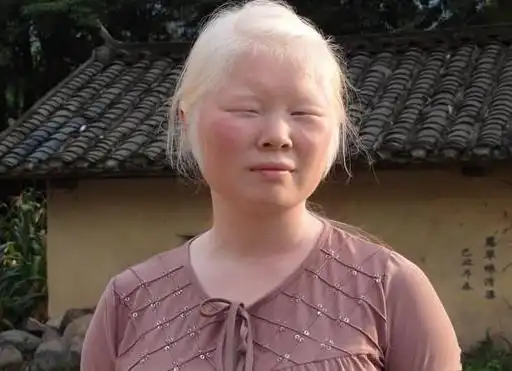 疾病大全 皮肤科 白化病