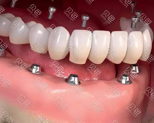 深圳龙岗种植牙多少钱一颗龙岗种植牙便宜又好牙科价格表