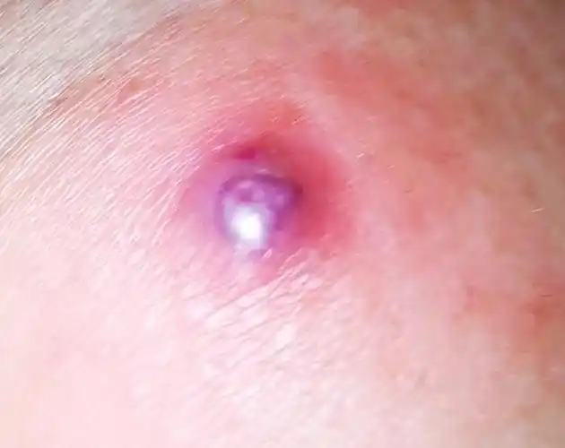 屁股上肿块周期性的好像是叫疖子有什么好办法治疗吗