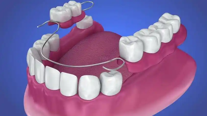 附2024吸附性义齿/种植牙/活动假牙费用参考_价格_支架_元起