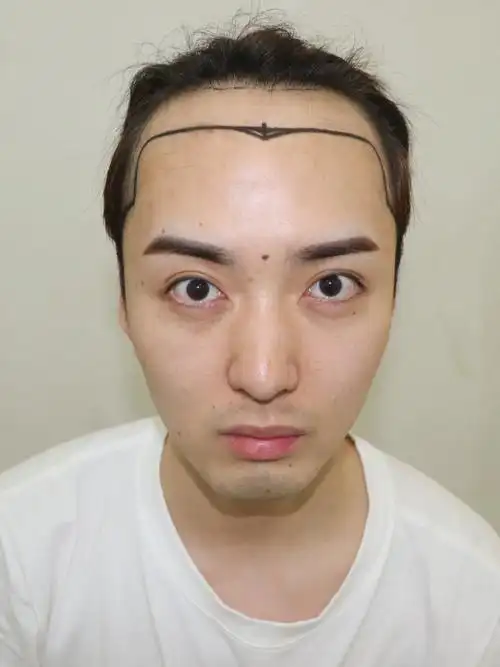 男生要是发际线太高真的太影响了.