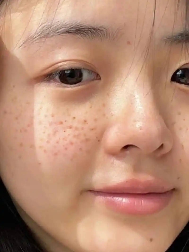 谁懂,之前脸上的斑点化妆都遮不住,现在脸上干干