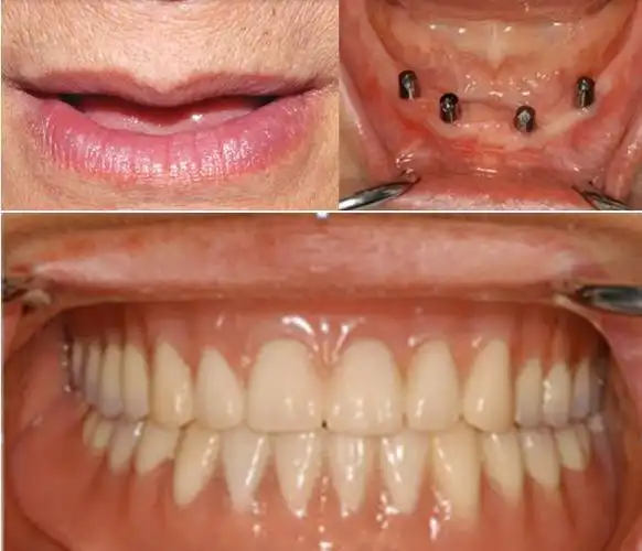 8月31号留美种植牙数字化种植牙手术直播会邀你见证