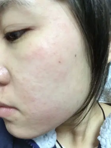 怀孕以来,皮肤一直过敏.不敢用药.请求医生帮忙解决.