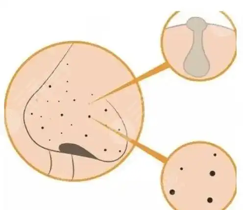 如何收缩鼻头毛孔小妙招!这几个有方法看完就会了!处理不当会更糟糕!