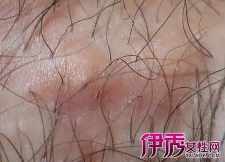 【图】阴毛囊炎症状硬疙瘩图合集 得此病该注意什么