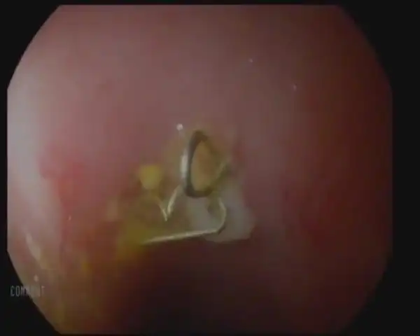 结直肠手术后吻合器的钛钉脱落是什么样的?对人体有哪些影响?