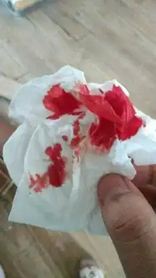 有没有三十四周出鼻血的宝妈 流血了好吓人