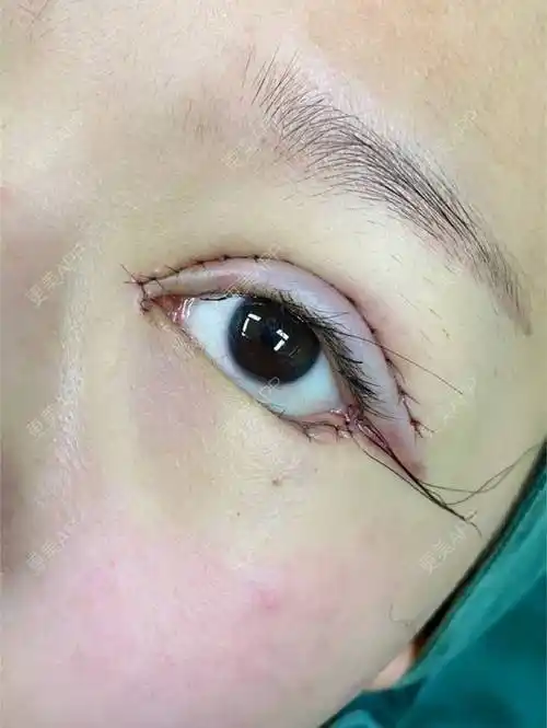 更美用户zgm62y2rf2的全切双眼皮日记