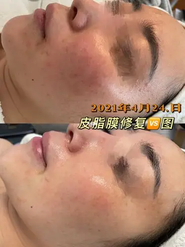 东营首家【德茉皮脂膜修复】——修复肌肤屏障_修复肌肤_万达广场soho