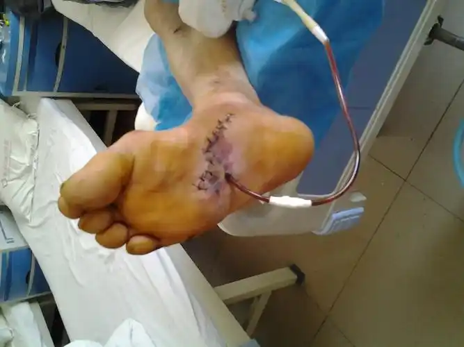 右足底皮肤贯通伤自制负压吸引