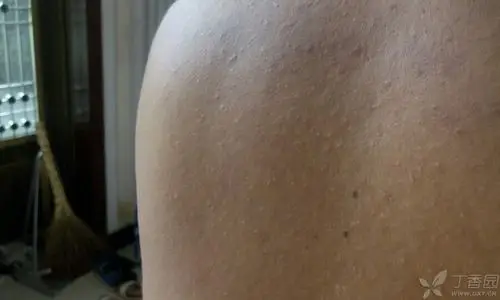 男,30岁,后背弥漫分布的密集皮疹,无不适症状,求助