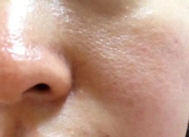 为何皮肤出油会毛孔粗大如何改善毛孔粗大问题