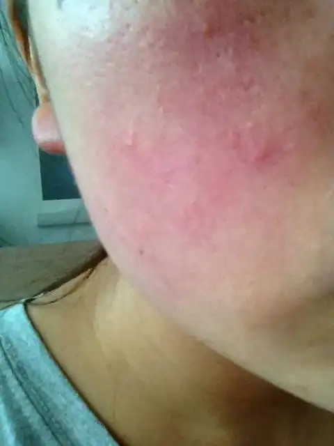 我之前用的一种护肤品过敏了,谁能有什么好的方法告诉我怎么解决?