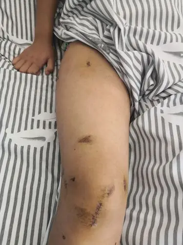 术后伤口愈合良好