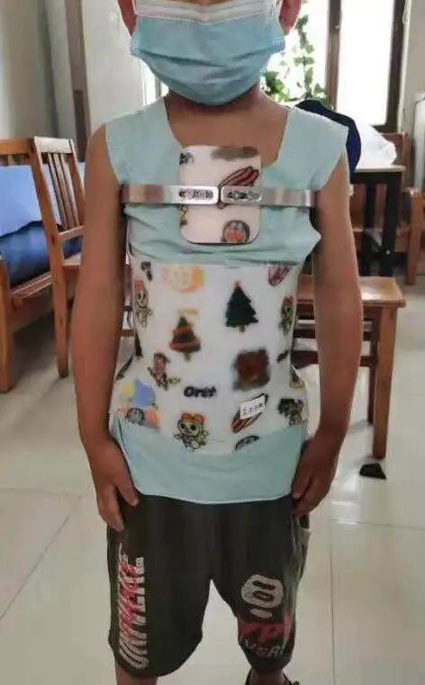 何谓鸡胸?鸡胸可以用矫形器吗?_鸡胸_介绍_治疗方式 - 好大夫在线