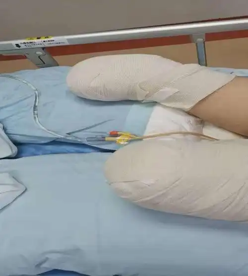 晚上约8点50分,在备战中的手术室,骨科副主任医师王森,医生王巨鹏