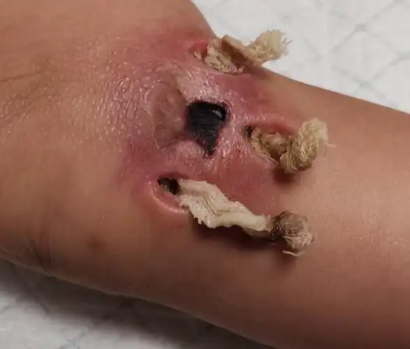 病情进展快,细菌毒力强,可引起广泛皮肤和筋膜坏死,全身毒血症,甚至