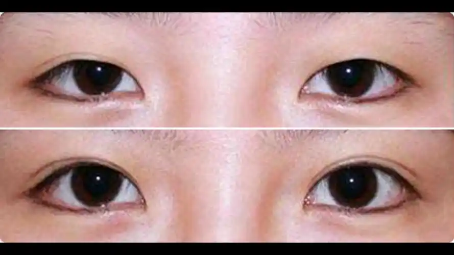埋线双眼皮效果对比图