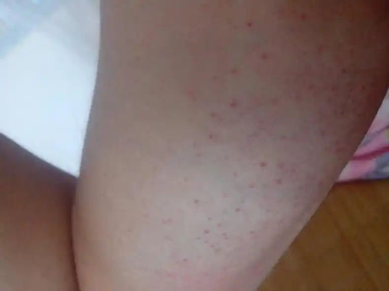 34岁女教师身长"小红点",确诊宫颈癌,医生:3种现象要当心了