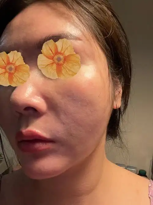 面部吸脂大坑,神经受损,身体大面积凹凸不平,下巴歪