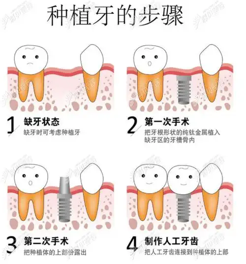 种植牙的步骤