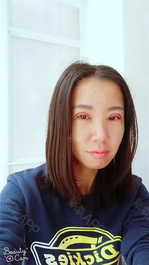 宝宝们这是刚刚做完双眼皮的第一天