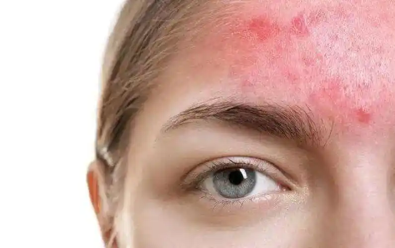 到底什么是"皮肤屏障受损"?很多人理解错了,难怪皮肤越来越差-时尚-中