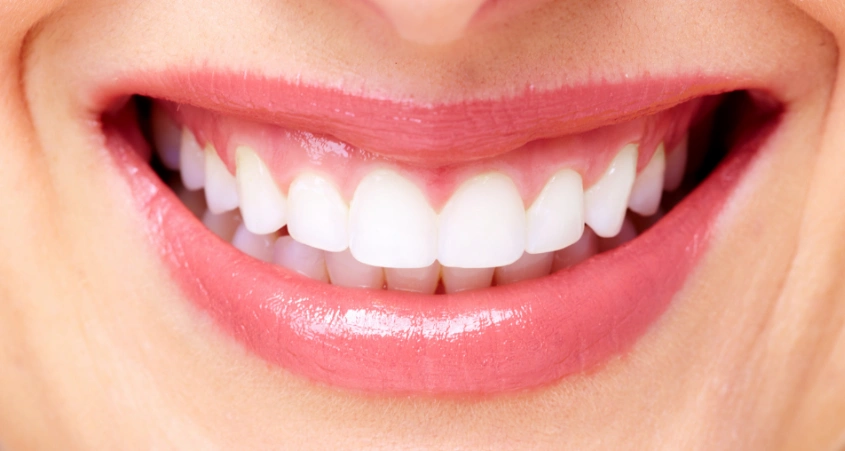 牙齿美白贴面