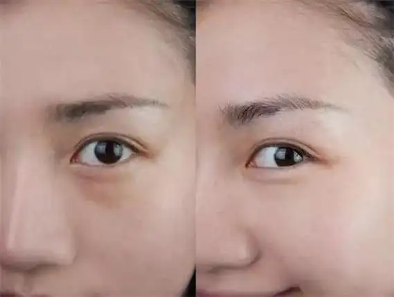 聊聊祛眼袋手术多久可以恢复自然,做完眼袋手术恢复期得多长时间