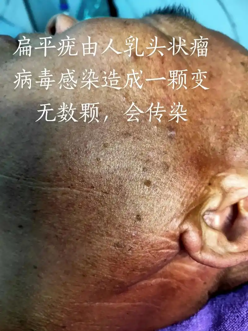 96世间所有温柔,也要留给爸爸一份#扁平疣#丝状疣 - 抖音