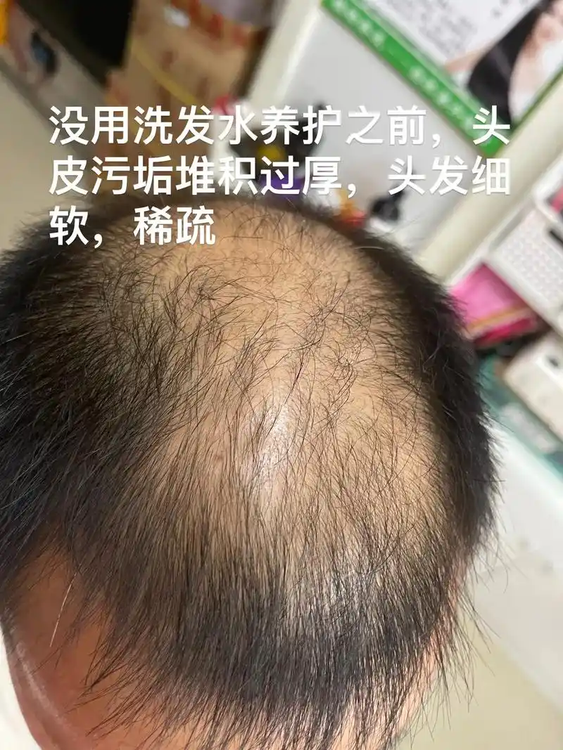 防脱生发 养发需要 - 抖音