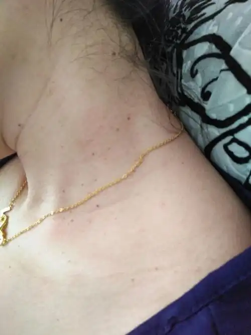 怀孕期间脖子长了好多瘊子可怎么办?